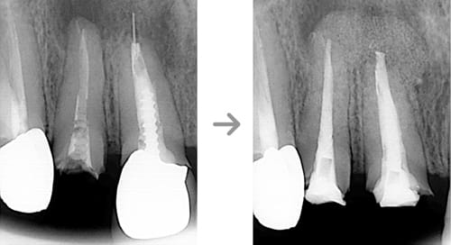 外科的歯内治療