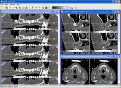 インプラント専用のシミュレーションソフトを導入