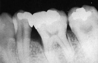 歯周外科の治療画像