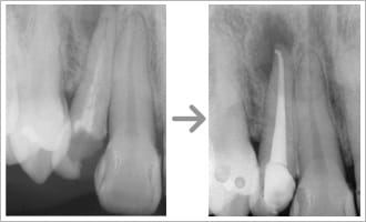 根管治療の治療画像