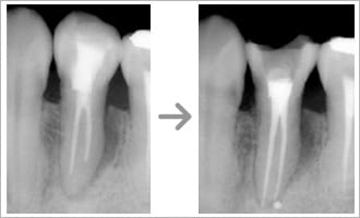 根管治療の治療画像